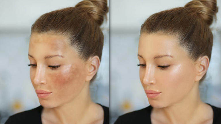 Dermatologist’s Tried and Tested Skincare Tips to Reduce Hyperpigmentation